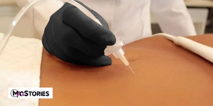 Carboxytherapy